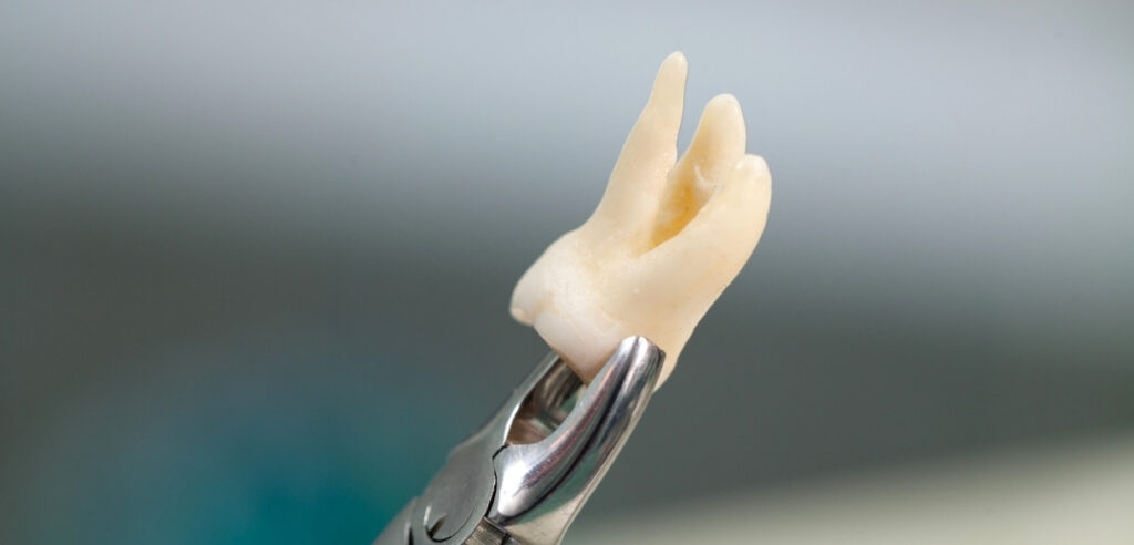Can You Use Mouthwash After Tooth Extraction? Find Out